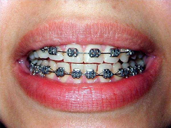 Correctores dentales para una saludable sonrisa