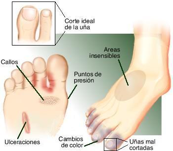 Tratamiento de hongos en pies